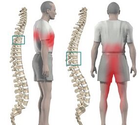 bolest v páteři s hrudní osteochondrózou