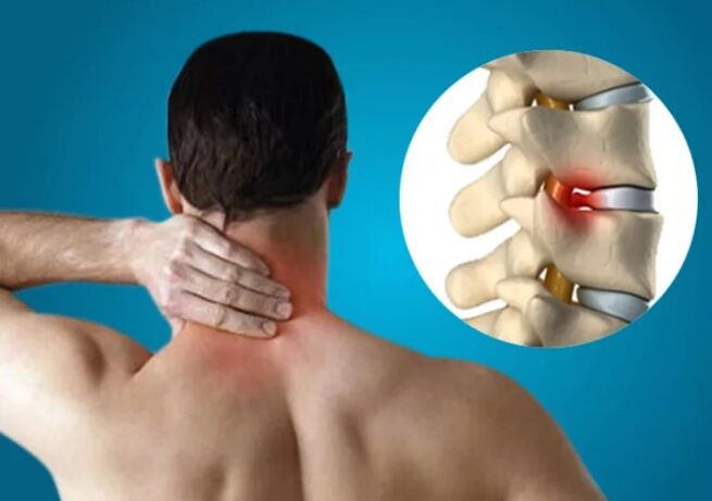 Cervikální osteochondrosis
