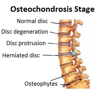 Etapy osteochondrosy