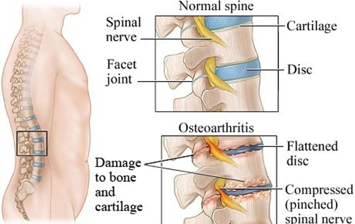 Rozdíl mezi zdravým diskem a disku s osteochondrosou